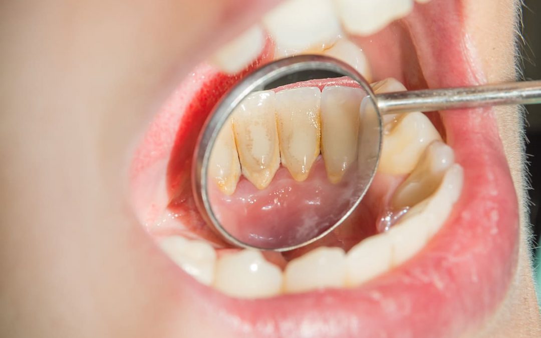 La Placa Dental: Más Compleja de lo que Piensas