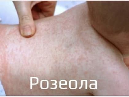Розеола - вирусная инфекция, которая чаще всего поражает маленьких детей в возрасте от 6 месяцев до 2 - 3 лет