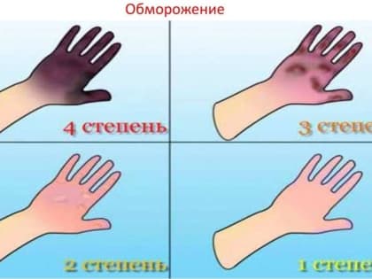 Обморожение