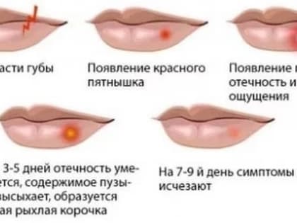 Простуда на губах: простой герпес
