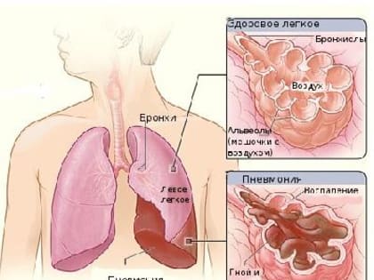 Вирусные пневмонии у детей