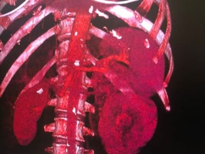 Рост заболеваемости раком почек в России