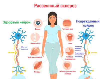 «Школа пациентов» для больных рассеянным склерозом проведет занятие в Есенинке