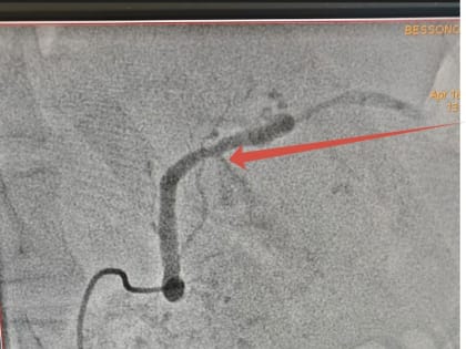 Липецкие хирурги за 6 часов операции спасли пациента с внутренним кровотечением