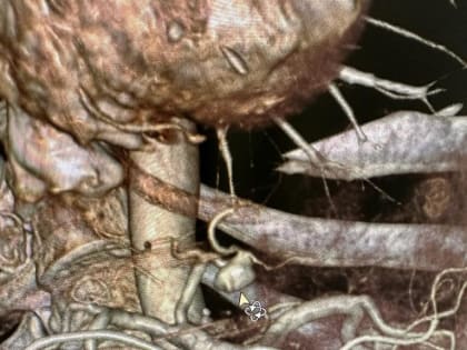 Уникальную операцию выполнили в Липецкой областной клинической больнице