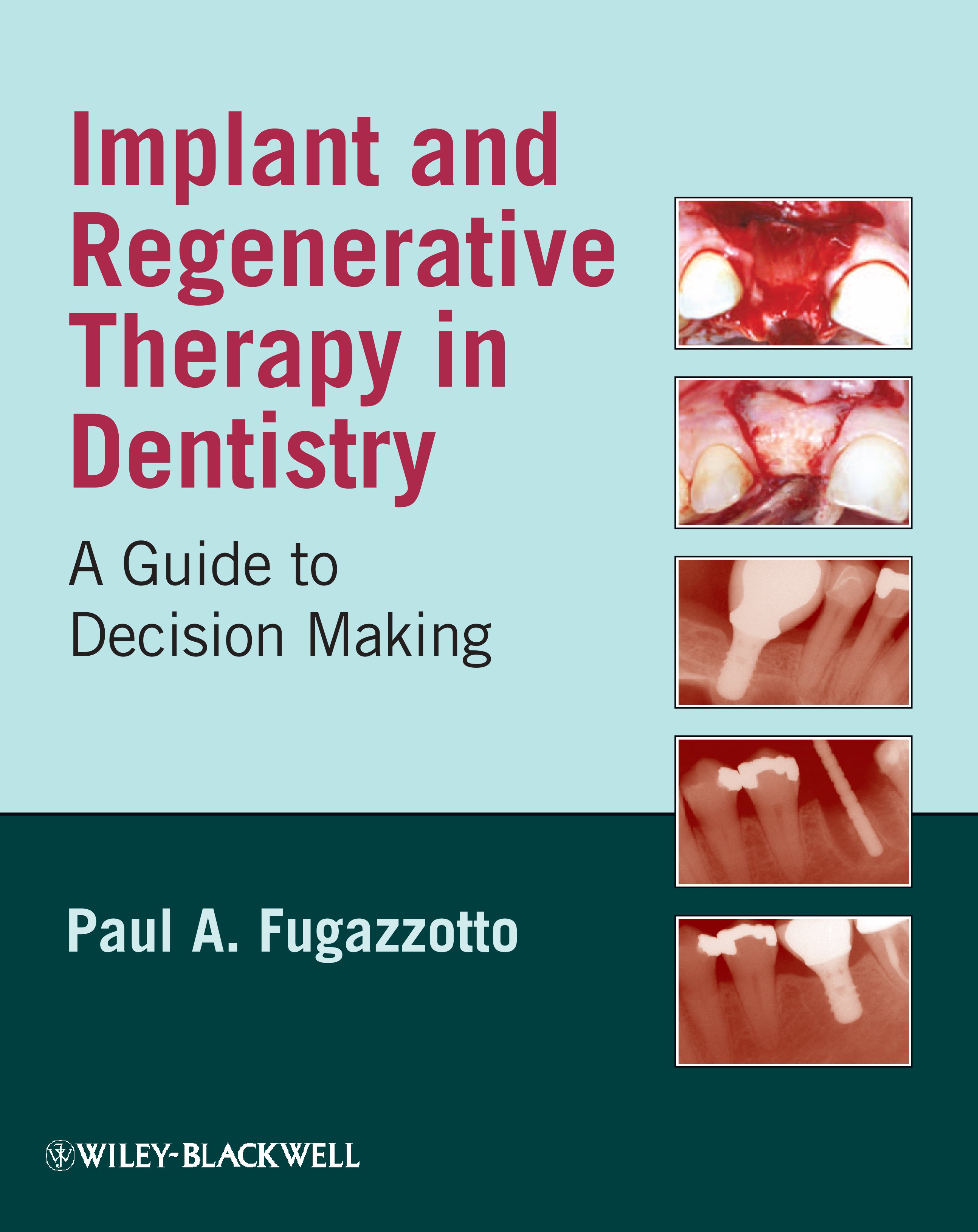 Tài liệu IMPLANT AND REGENERATIVE THERAPY IN DENTISTRY A GUIDE TO DECISION MAKING docx
