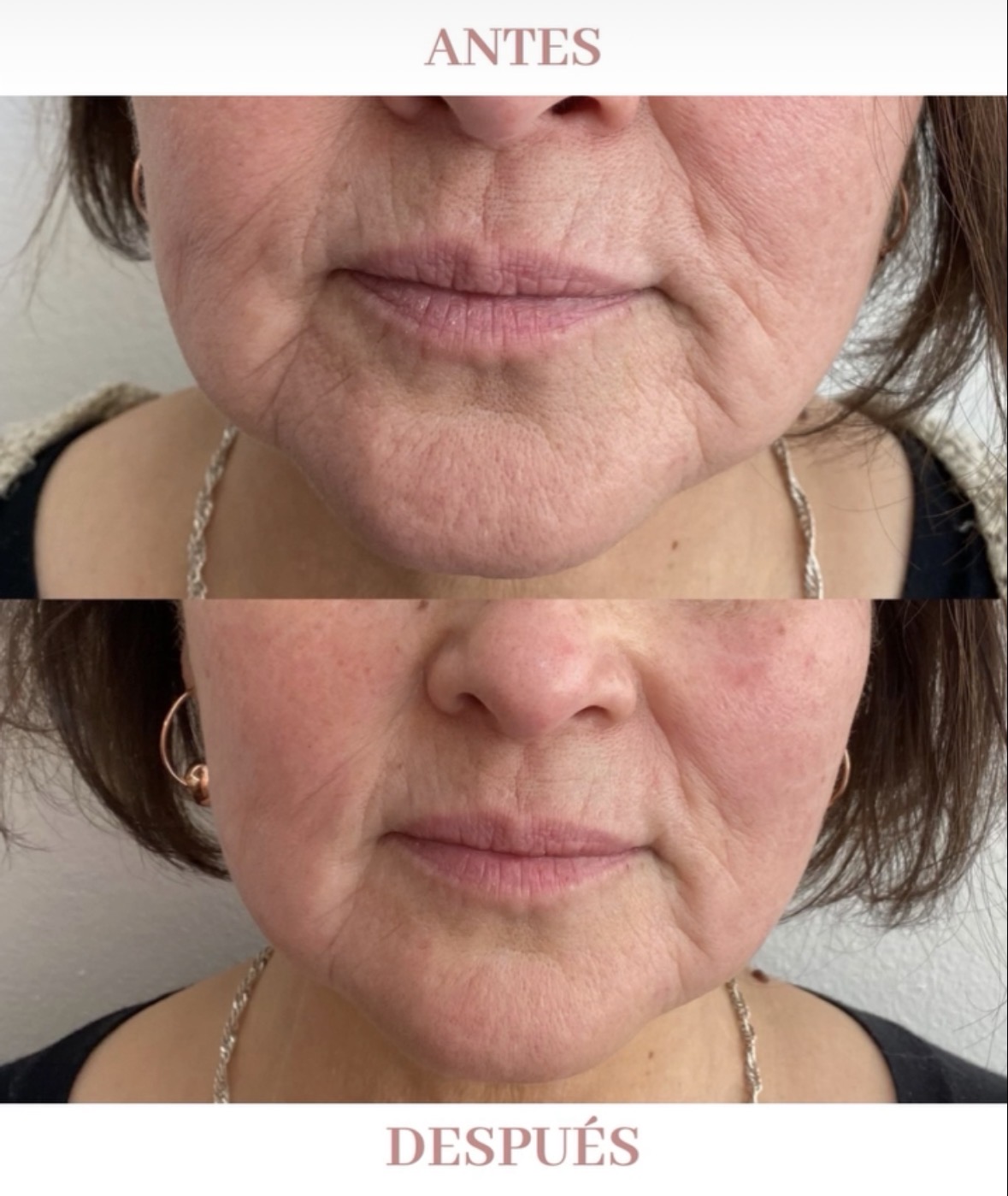 Antes y después - Armonización Facial
