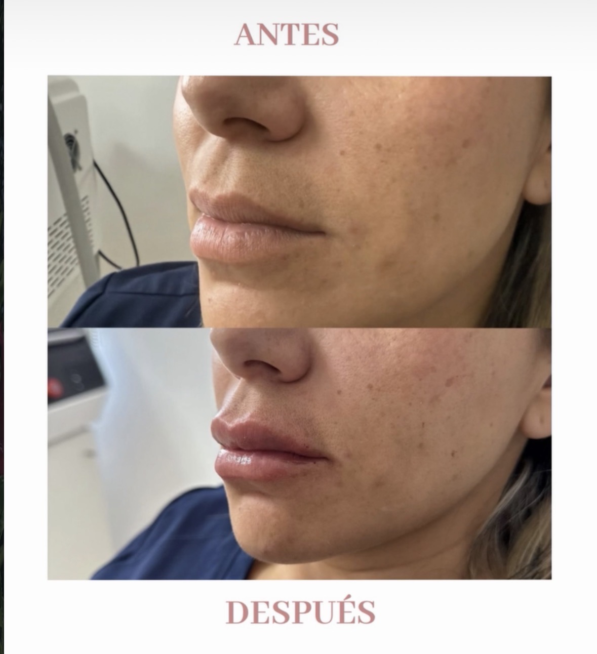 Antes y después - Armonización Facial