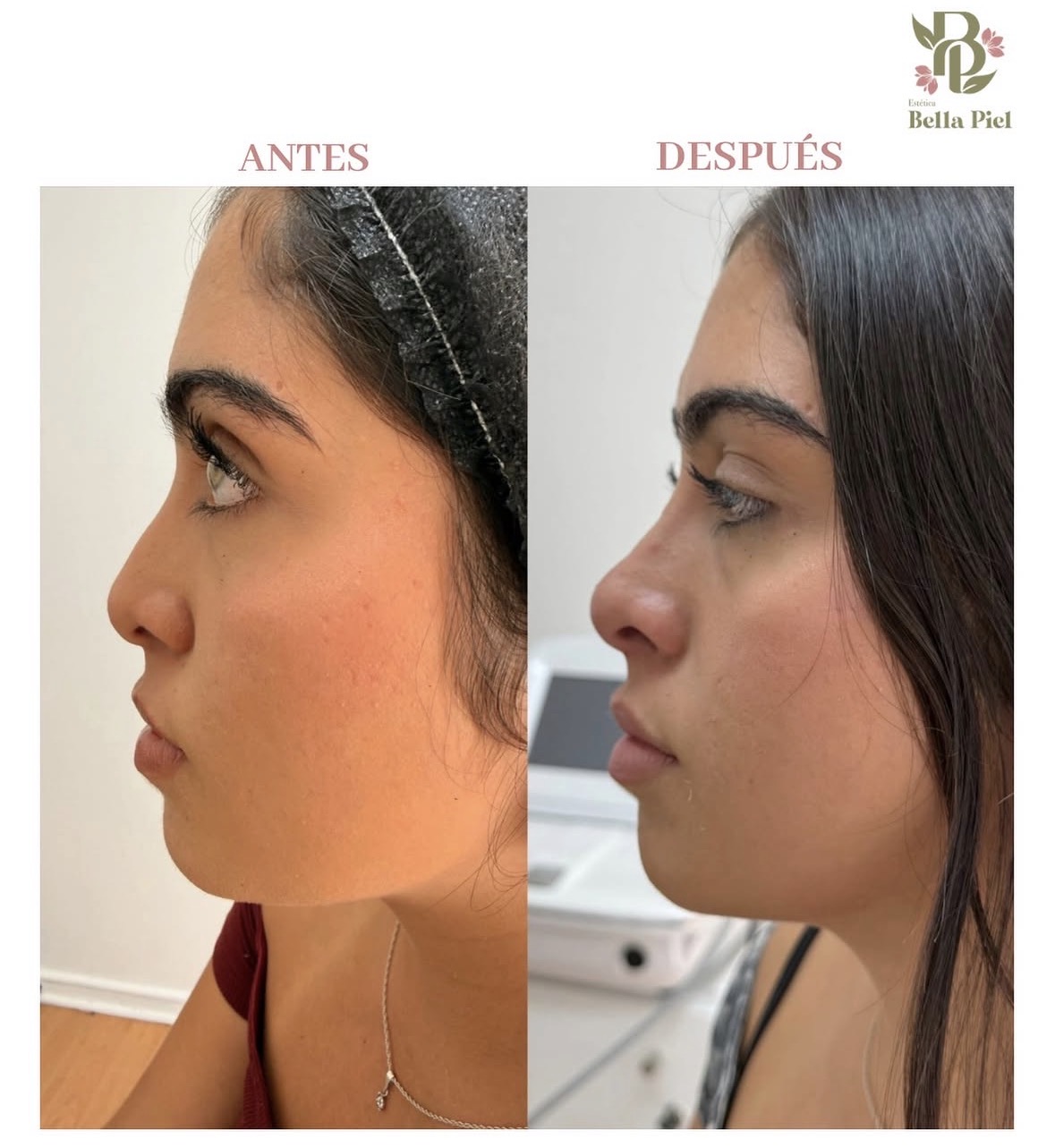 Antes y después - Armonización Facial