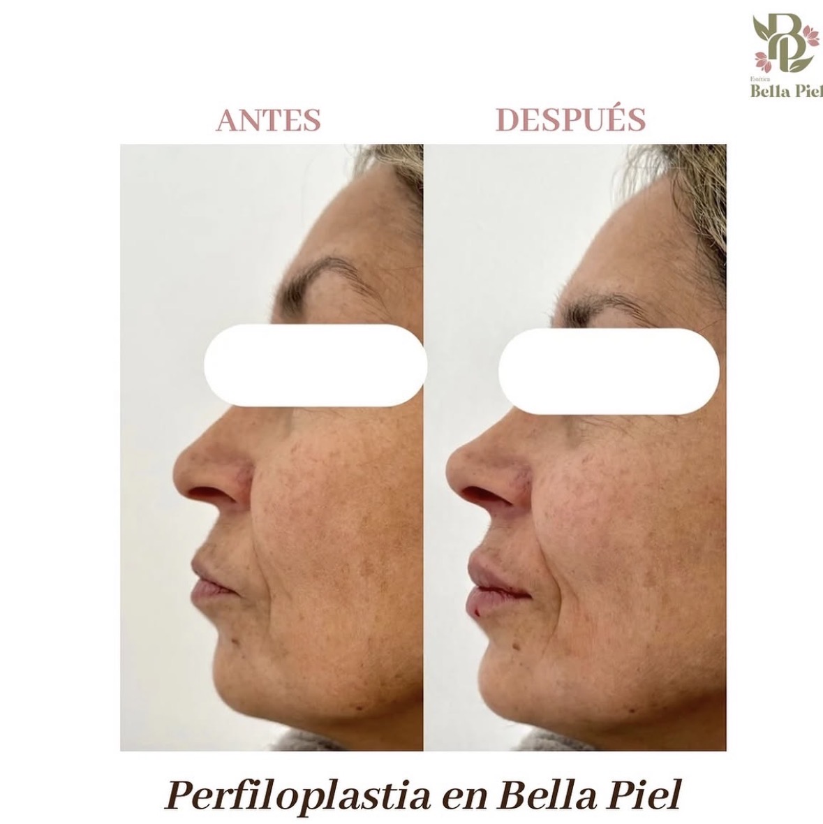 Antes y después - Armonización Facial