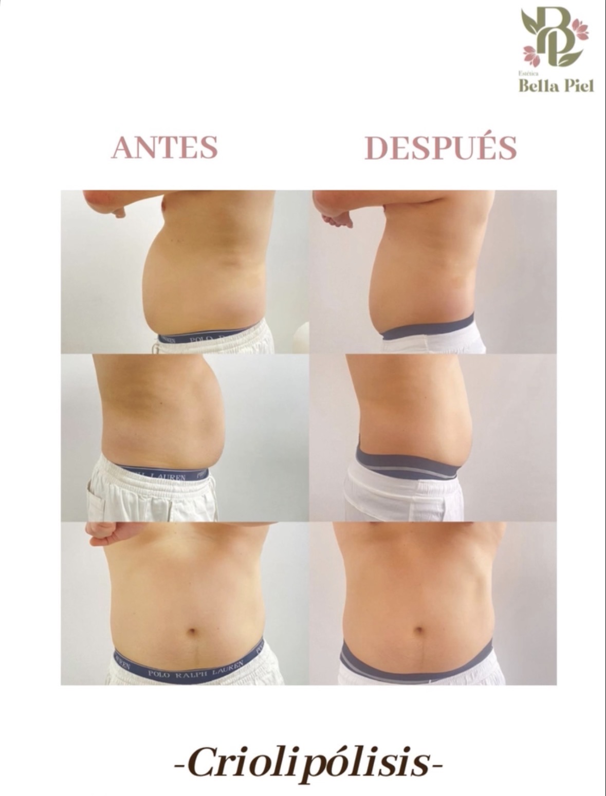 Antes y después - Corporal