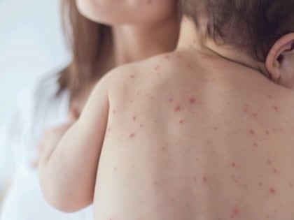 Острожно - корь!