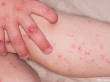 Заболевания в Краснодарском крае: новые случаи заражения