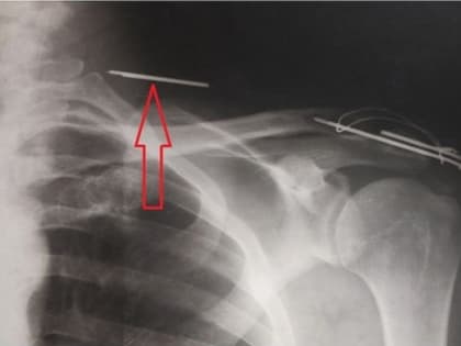 Врачи воронежской поликлиники вытащили пациенту спицу из шеи