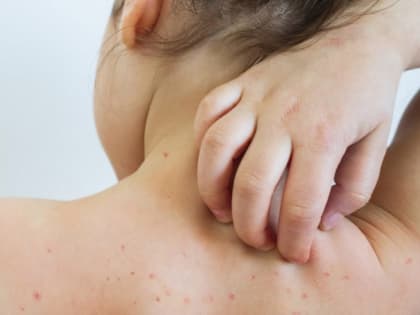 Специалисты объяснили единичные случаи кори в Костромской области миграцией