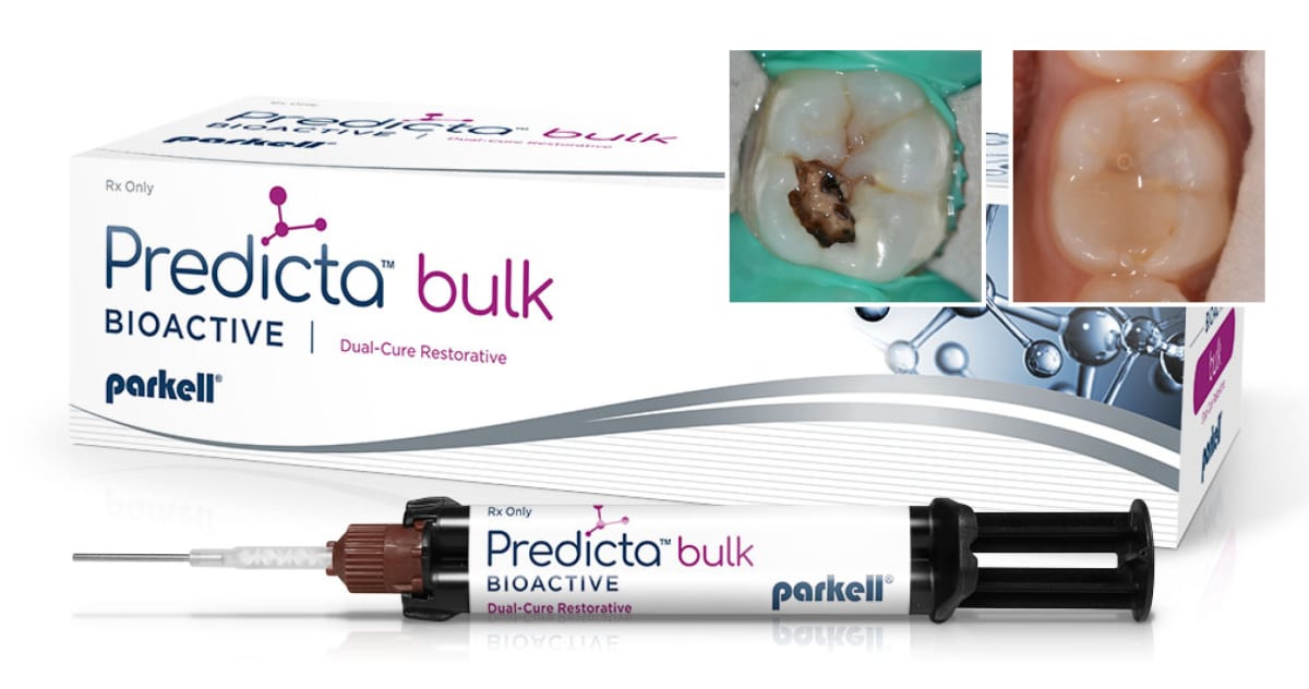 Predictable management of deep carious lesion with bioactive restorative materials. Jacobsen Dental