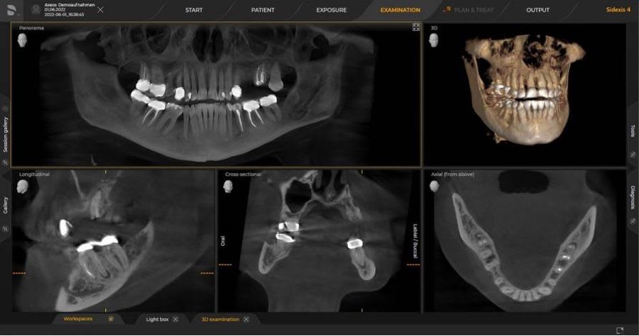 CBCT uten SCOUT-funksjon