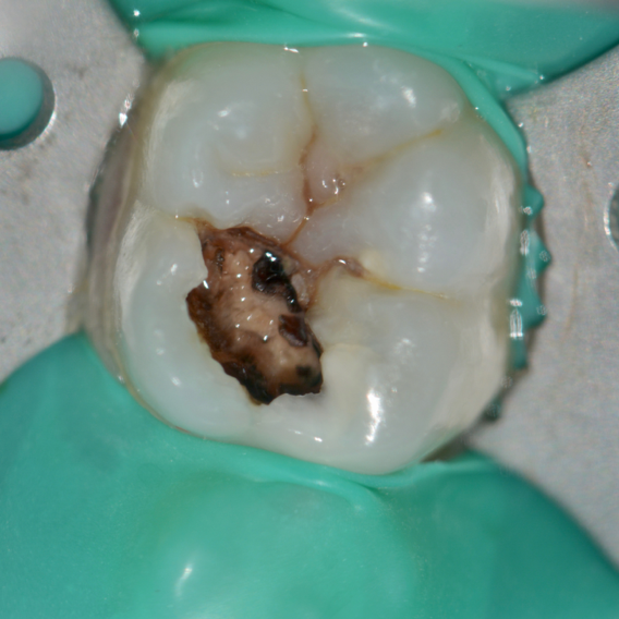 Predictable management of deep carious lesion with bioactive