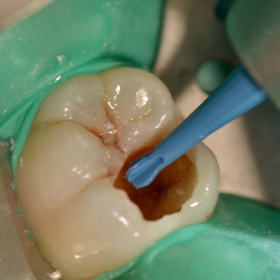 Predictable management of deep carious lesion with bioactive