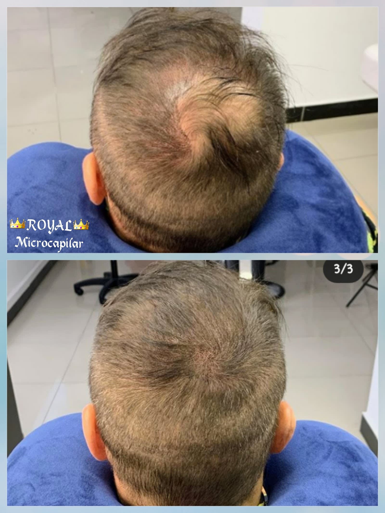 Aplicação de micropigmentação capilar no estúdio da Royal, Rio de Janeiro