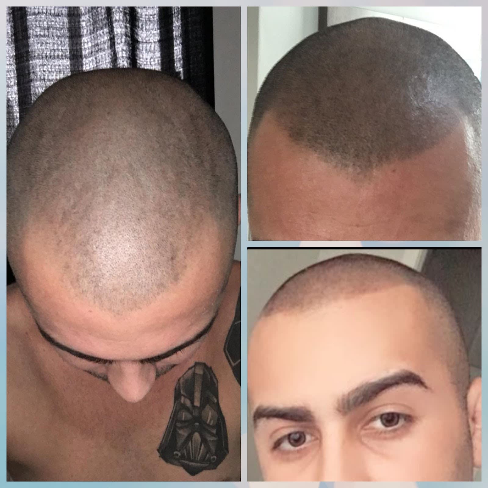 Resultado de micropigmentação capilar em cliente da Royal, Rio de Janeiro