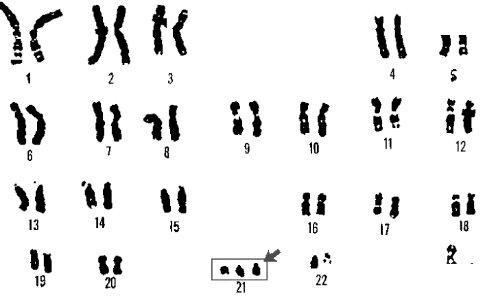 Karyotype showing Down's syndrome with trisomy 21