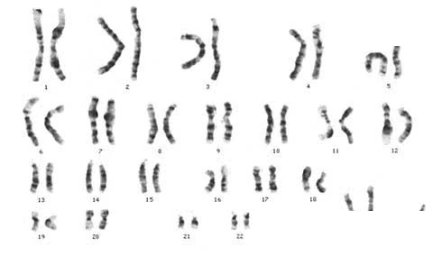 Karyotype of Klinefelter's syndrome showing XXY chromosomes