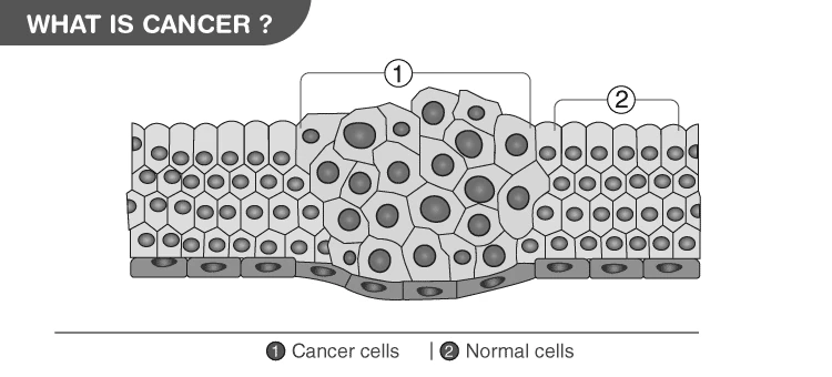 Microscopic view of cancer cells