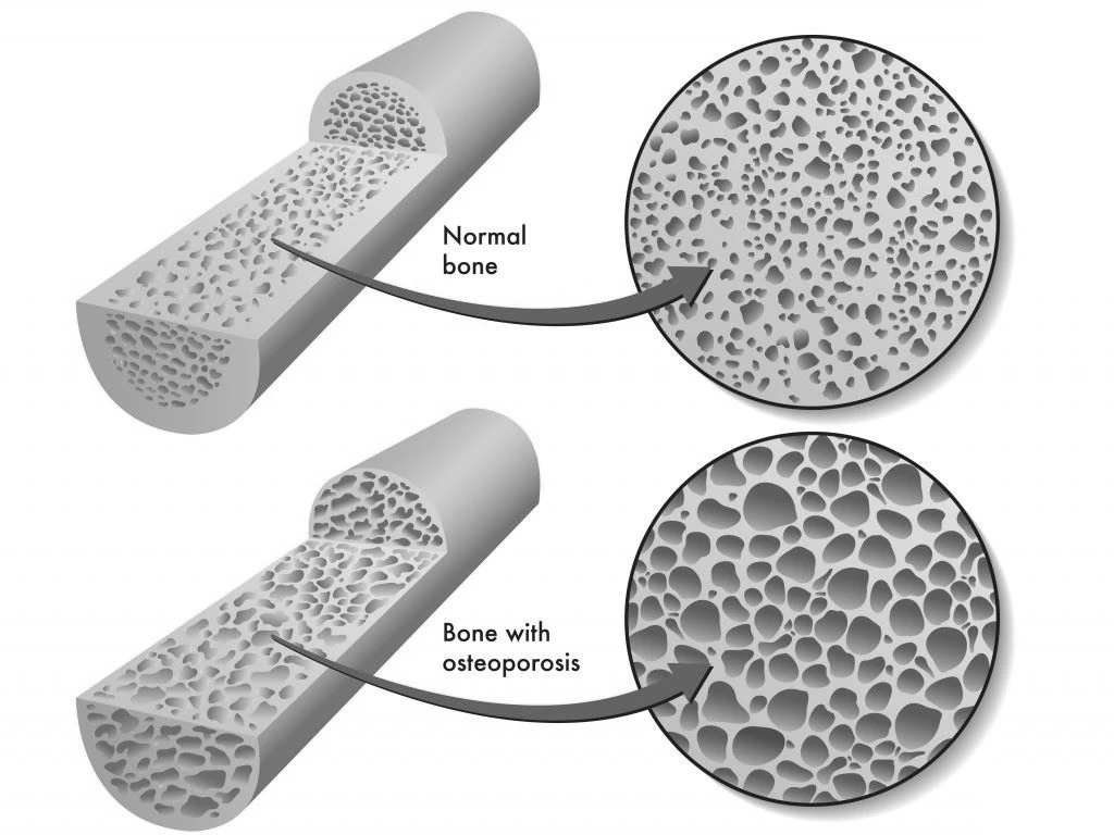 Illustration showing muscle spasms due to tetany