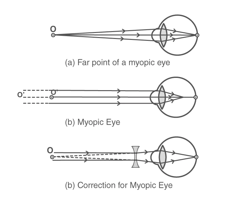 Diagram illustrating Myopia where light focuses before the retina