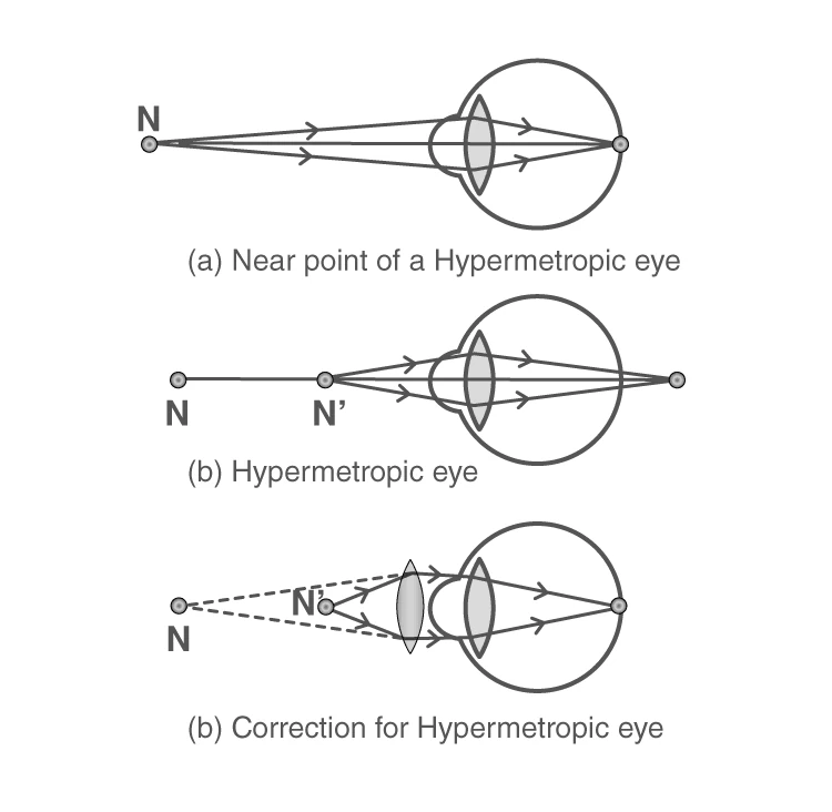 Diagram showing Hypermetropia where light focuses behind the retina