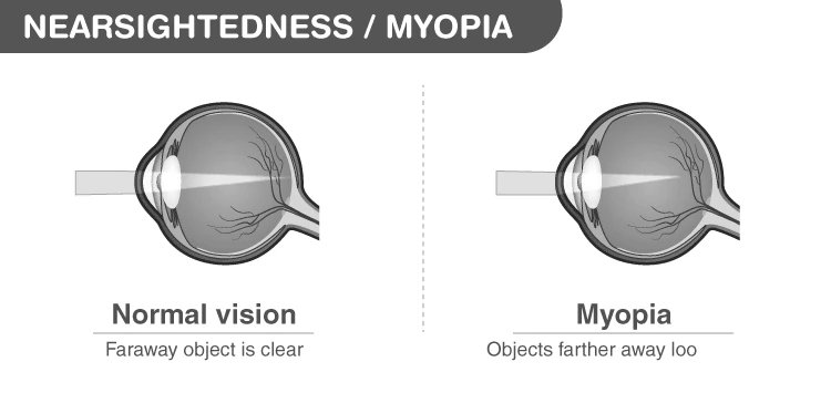 Illustration of Myopia showing eye focusing