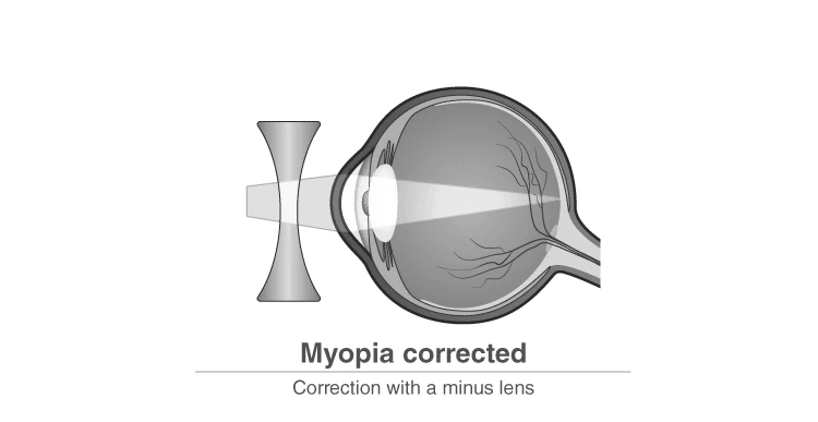 Diagram showing nearsightedness and image formation