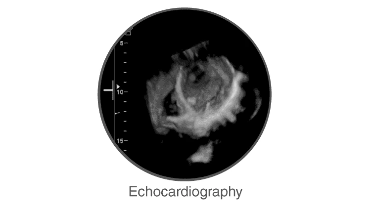 Echocardiography heart imaging