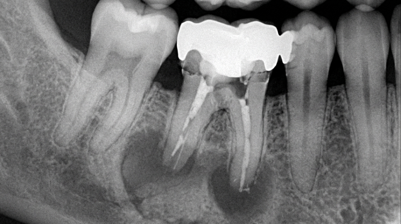 Зуб с коронкой и признаками неприятного запаха из-под нее на рентгеновском снимке