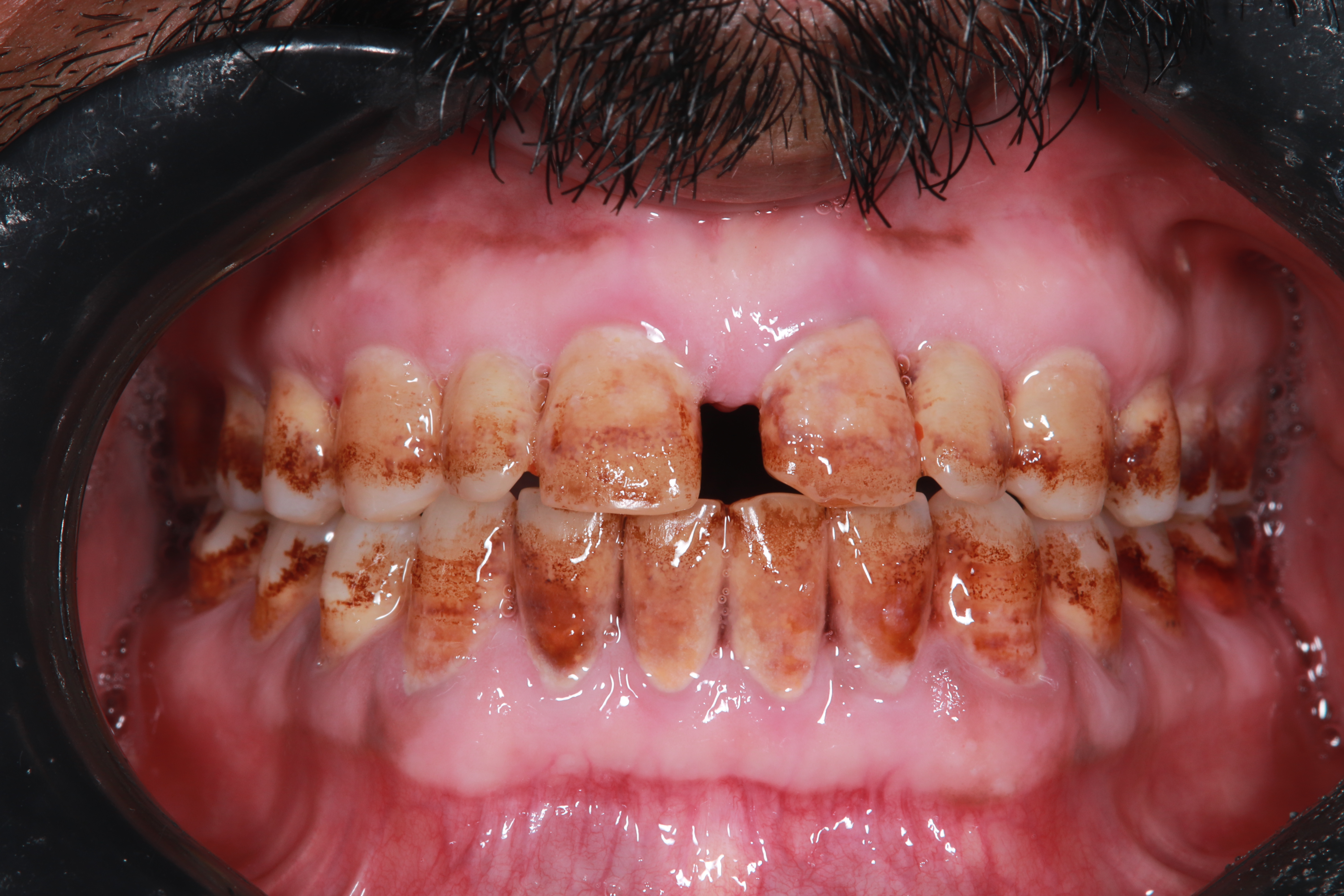 Premium Cosmetic Transformation - Before