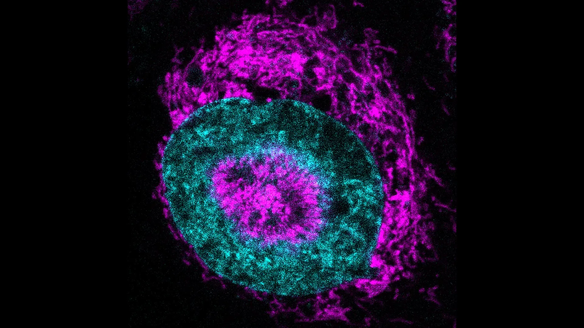 Microscopic image of cancer cells confined within a matrix, suitable for illustrating cell motility and mitochondrial influence in metastasis.