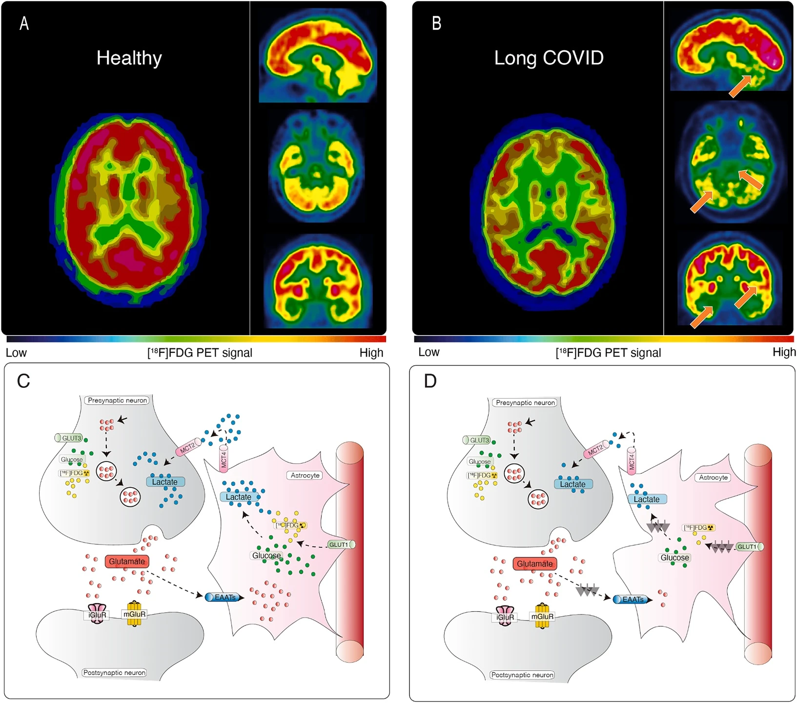 Detailed medical visualization showing brain imaging differences in Long COVID patients, with professional-grade resolution.
