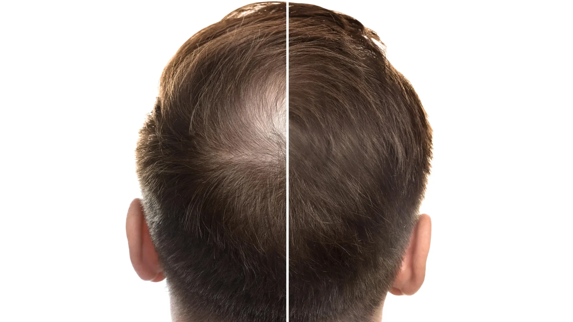 Before and after images showing hair regrowth in a subject receiving treatment, demonstrating improvement in baldness.