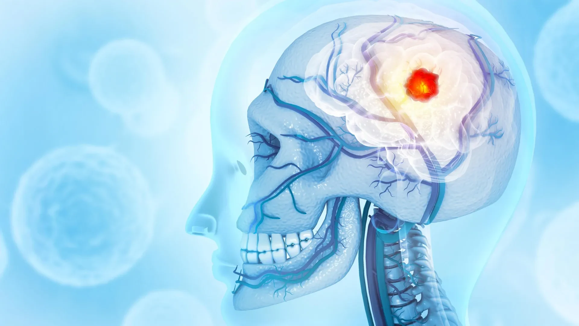 Detailed imaging of bone cancers affecting the skull, suitable for showing structural changes related to glioblastoma.