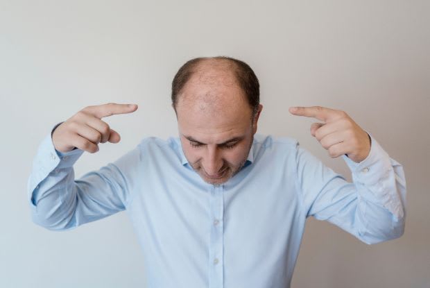 man pointing at his balding