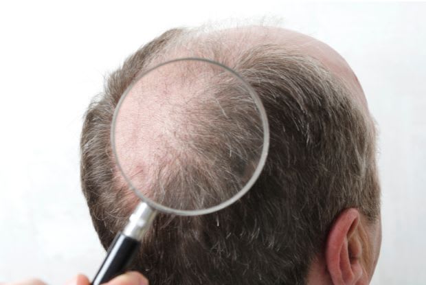 bald spot under magnifying glass