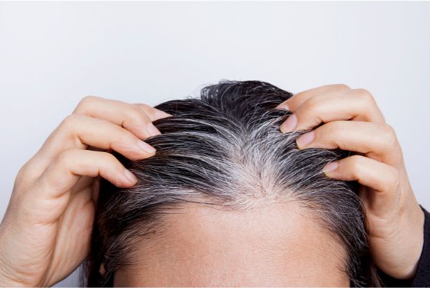 female pattern hair loss