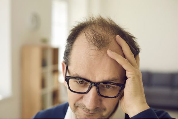 man experiencing male-pattern hair loss