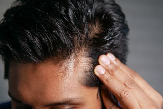 male pattern hair loss