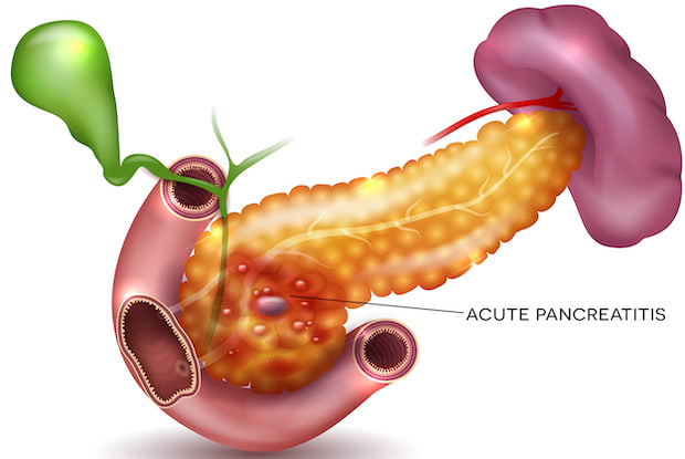 A graphic titled “acute pancreatitis” featuring a pancreas suffering from acute pancreatitis.