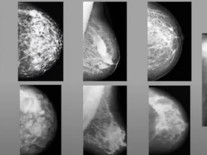 Диагностировать рак будет искусственный интеллект от калужских разработчиков