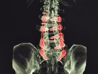 Швейцарские врачи вернули пациенту с болезнью Паркинсона возможность ходить