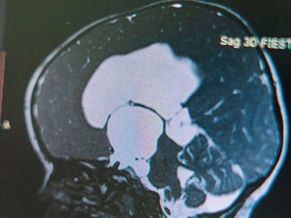 Неделя сохранения здоровья головного мозга проходит в Калуге