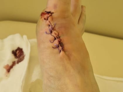 Таблетки или операция уберут надоевшую косточку на ноге?